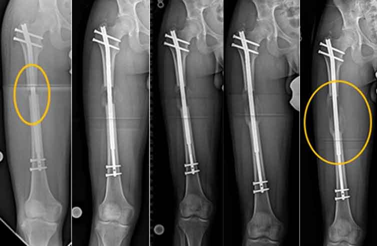 osteotomi pembedahan tambah ketinggian 79