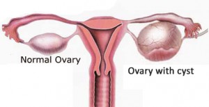 ovarian cyst