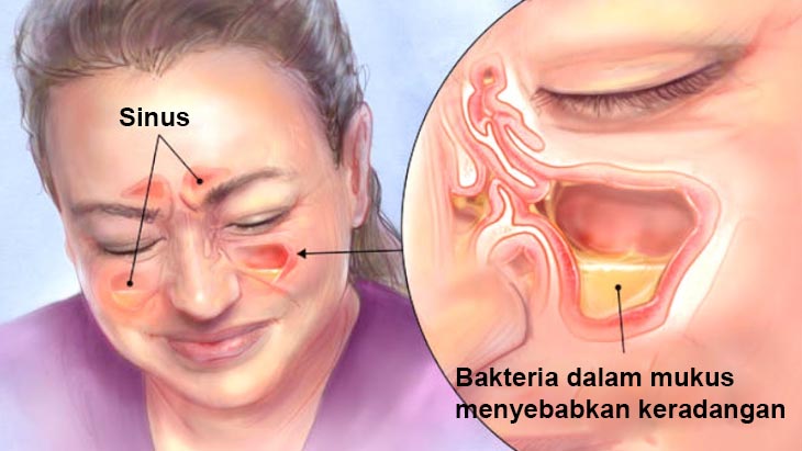 penyakit sinusitis benarkah penyakit sinusitis tak boleh minum milo lagi