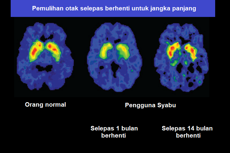 perbezaan otak bagi pengguna yang berhenti dan bukan pengguna syabu