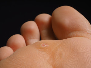 plantar wart dollar paid 300x225