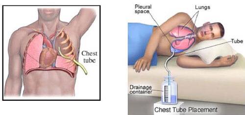 pleural effusion