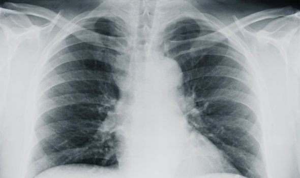 pneumonic plague jangkitan pneumonia