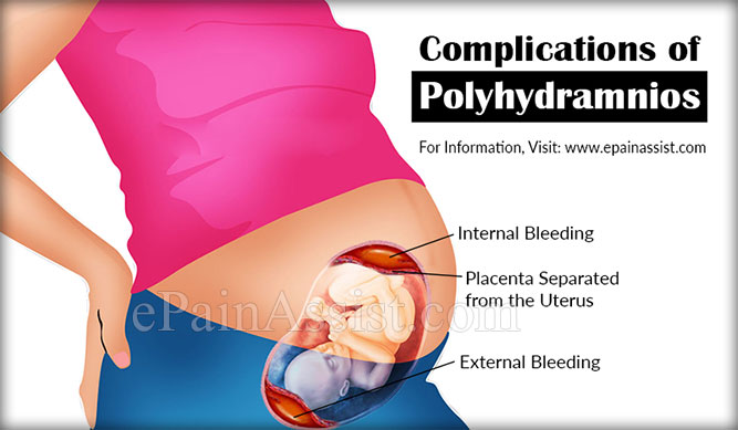 polyhydramnios