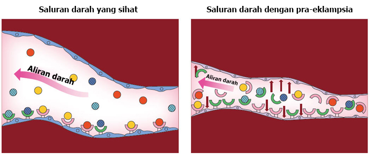 pra elampsia amaran bahaya sebelum sawan ketika hamil 4