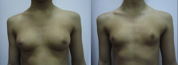 prepubertal gynecomastia