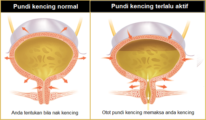 pundi kencing terlalu aktif