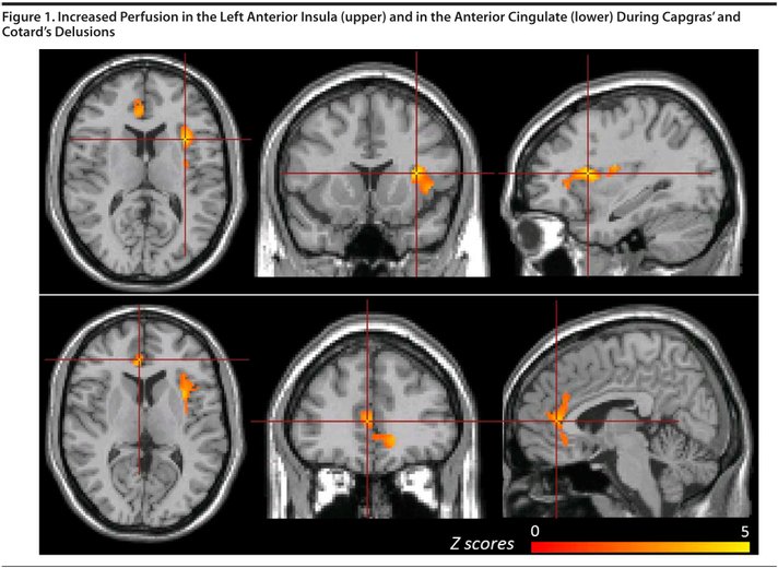 scan otak pesakit cotard delusion