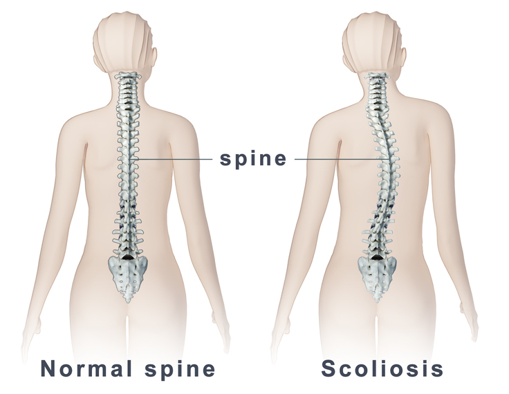 socliosis