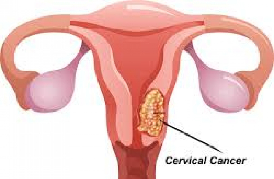 spermbot merawat barah serviks