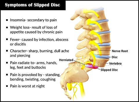 tanda tanda dan simptom slipped disc