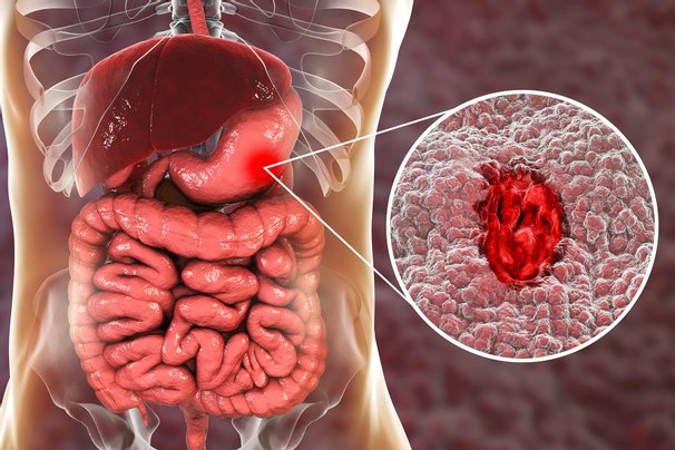 ulcer perut boleh berjangkit