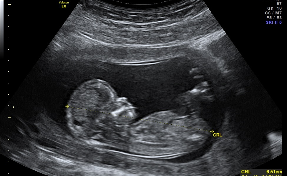 ultrasound scan