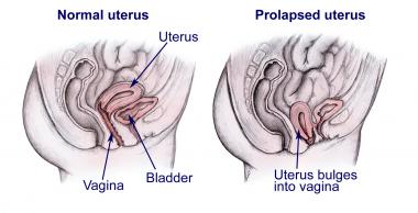 uterine prolapse