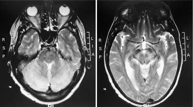 west nile encephalitis