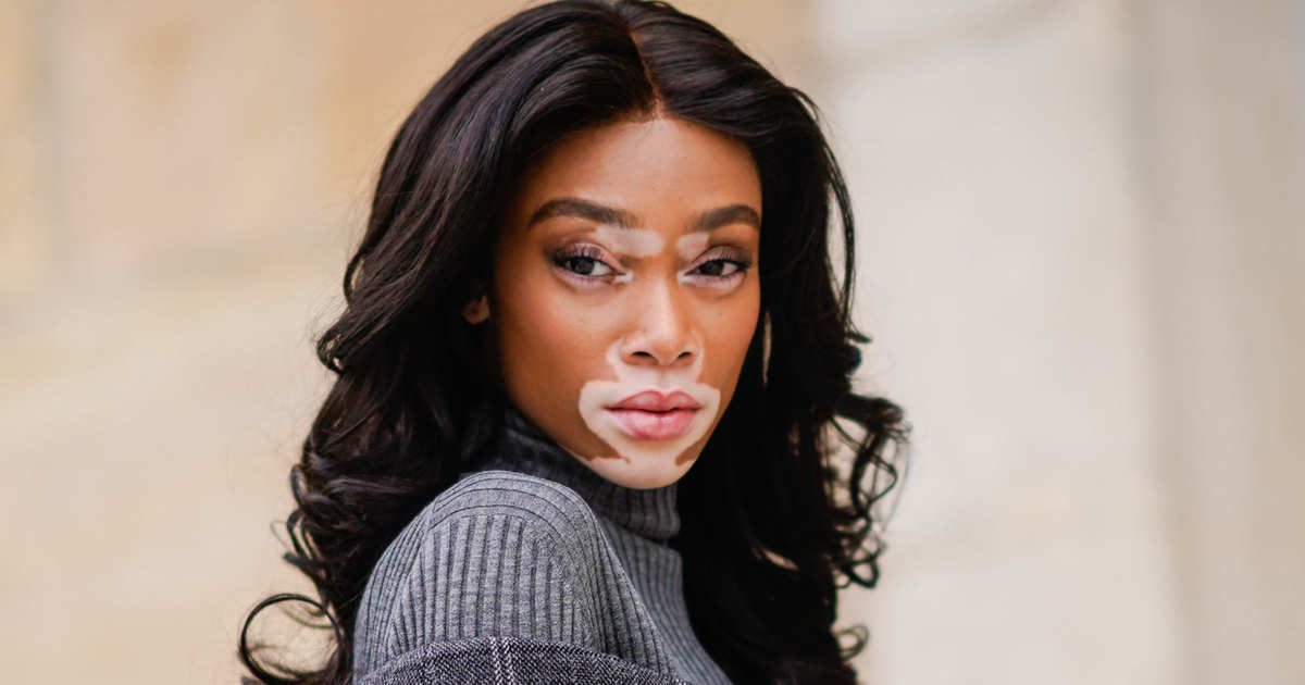 winnie harlow 7 anomali genetik yang menjadikan manusia unik