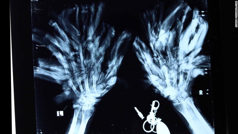 xray epidermodysplasia verruciformis