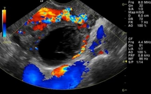 Apakah Ovarian Cyst & Kaitannya Dengan Kesuburan Wanita & Kehamilan?