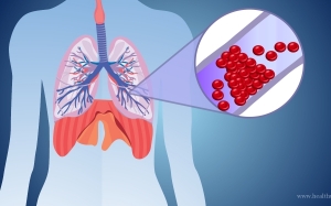 Pulmonary Embolism : Lebih Kerap Membunuh Ibu-Ibu Melayu