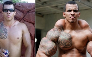 Tangan Terpaksa Dipotong Kerana Penyalahgunaan Synthol